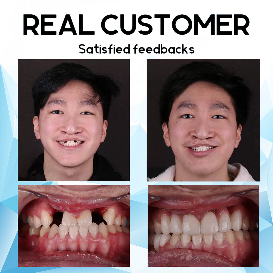 šFurzero⢠Silicone Reline Denture Setš¦·āØš„ Limited Time Discount: 75% OFF