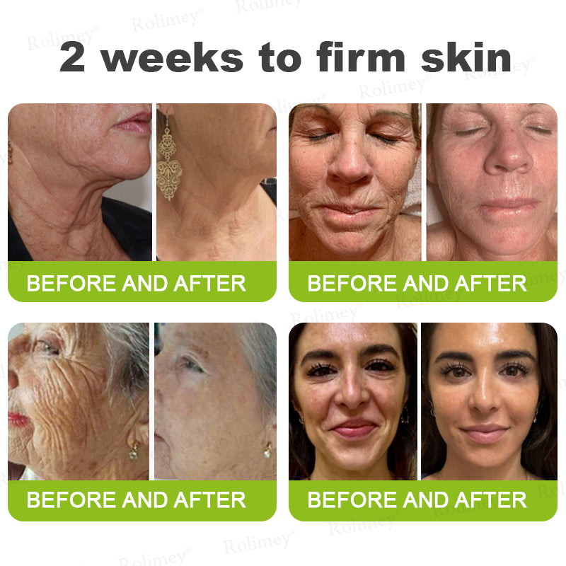 🏅👨‍⚕️Made and shipped from the USA 💫Rolimey® Botox & Vita-A Retinol Shot Wrinkle-Lift Tightening cream - Last Day Promotion 70% OFF