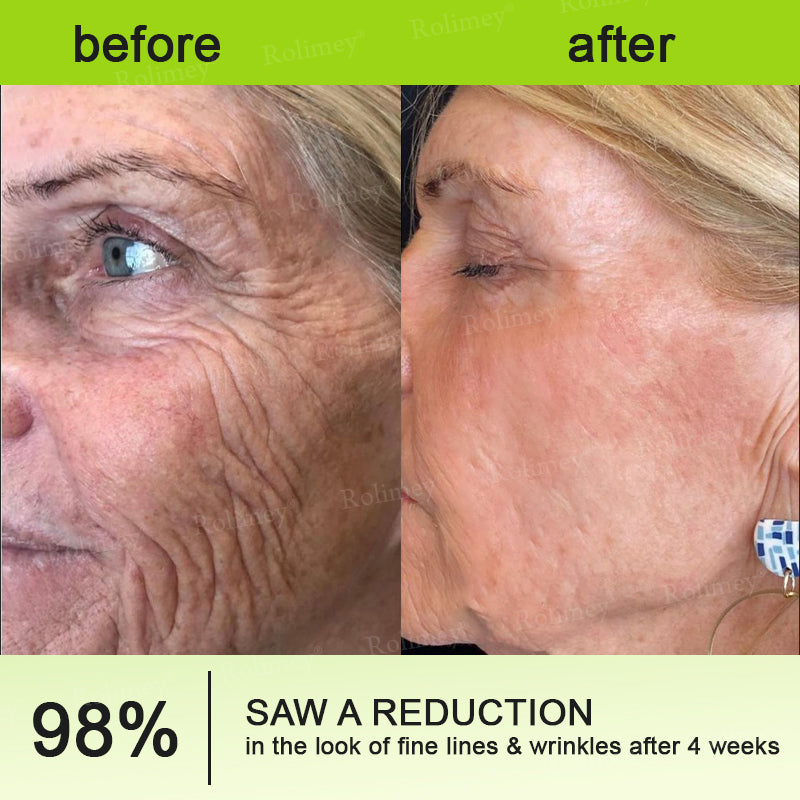 🏅👨‍⚕️Made and shipped from the USA 💫Rolimey® Botox & Vita-A Retinol Shot Wrinkle-Lift Tightening cream - Last Day Promotion 70% OFF
