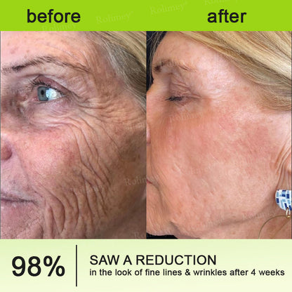 🏅👨‍⚕️Made and shipped from the USA 💫Rolimey® Botox & Vita-A Retinol Shot Wrinkle-Lift Tightening cream - Last Day Promotion 70% OFF
