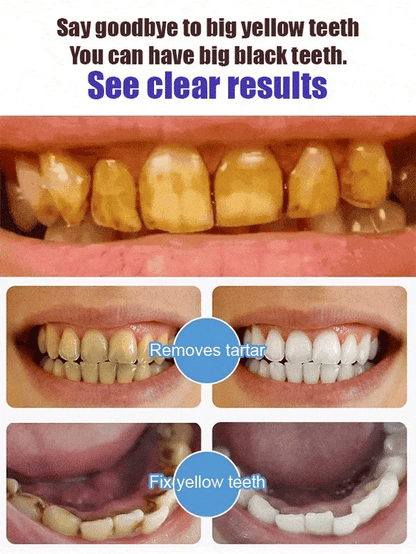 Furzero™ SP-6 Probiotic Ultra Whitening Toothpaste🪥🦷👨‍⚕️Recommendation🔥75% OFF🔥