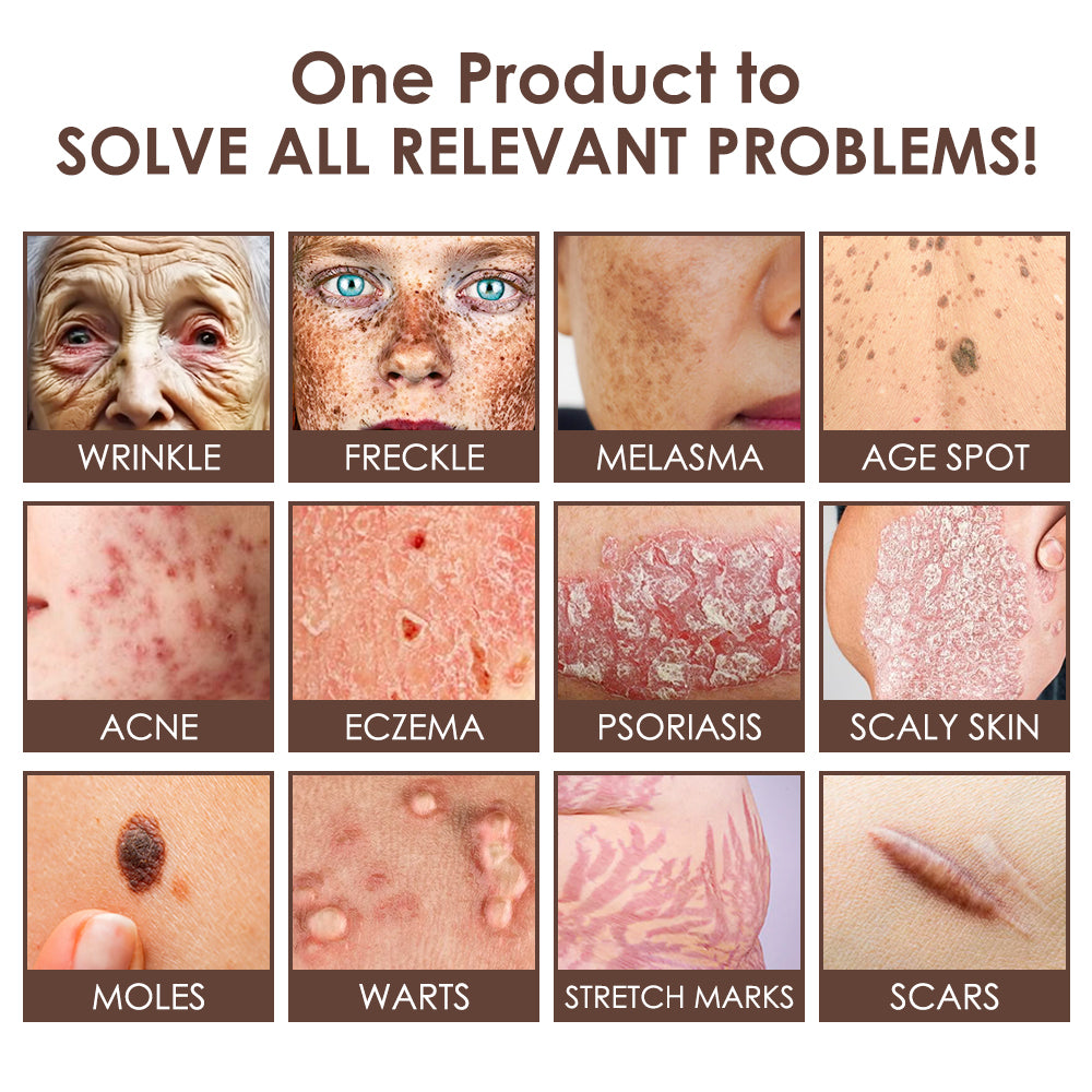 𝐅𝐃𝐀 𝐎𝐟𝐟𝐢𝐜𝐢𝐚𝐥: 𝐙𝐯𝐨𝐞𝐯𝐨® 𝐓𝐚𝐥𝐥𝐨𝐰 𝐁𝐞𝐞 𝐕𝐞𝐧𝐨𝐦 𝐒𝐤𝐢𝐧 𝐑𝐞𝐬𝐭𝐨𝐫𝐚𝐭𝐢𝐨𝐧 𝐂𝐫𝐞𝐚𝐦 - 𝐀𝐧𝐭𝐢-𝐚𝐠𝐢𝐧𝐠, 𝐇𝐲𝐝𝐫𝐚𝐭𝐢𝐧𝐠, 𝐒𝐤𝐢𝐧 𝐅𝐢𝐫𝐦𝐢𝐧𝐠 & 𝐋𝐢𝐟𝐭𝐢𝐧𝐠, 𝐒𝐤𝐢𝐧 𝐑𝐞𝐩𝐚𝐢𝐫, 𝐄𝐯𝐞𝐧 𝐓𝐨𝐧𝐞, 𝐀𝐜𝐧𝐞 𝐚𝐧𝐝 𝐃𝐚𝐫𝐤 𝐒𝐩𝐨𝐭 𝐓𝐫𝐞𝐚𝐭𝐦𝐞𝐧𝐭, 𝐖𝐚𝐫𝐭 𝐚𝐧𝐝 𝐌𝐨𝐥𝐞 𝐑𝐞𝐦𝐨𝐯𝐚𝐥, 𝐚𝐧𝐝 𝐏𝐬𝐨𝐫𝐢𝐚𝐬𝐢𝐬 𝐑𝐞𝐥𝐢𝐞𝐟.