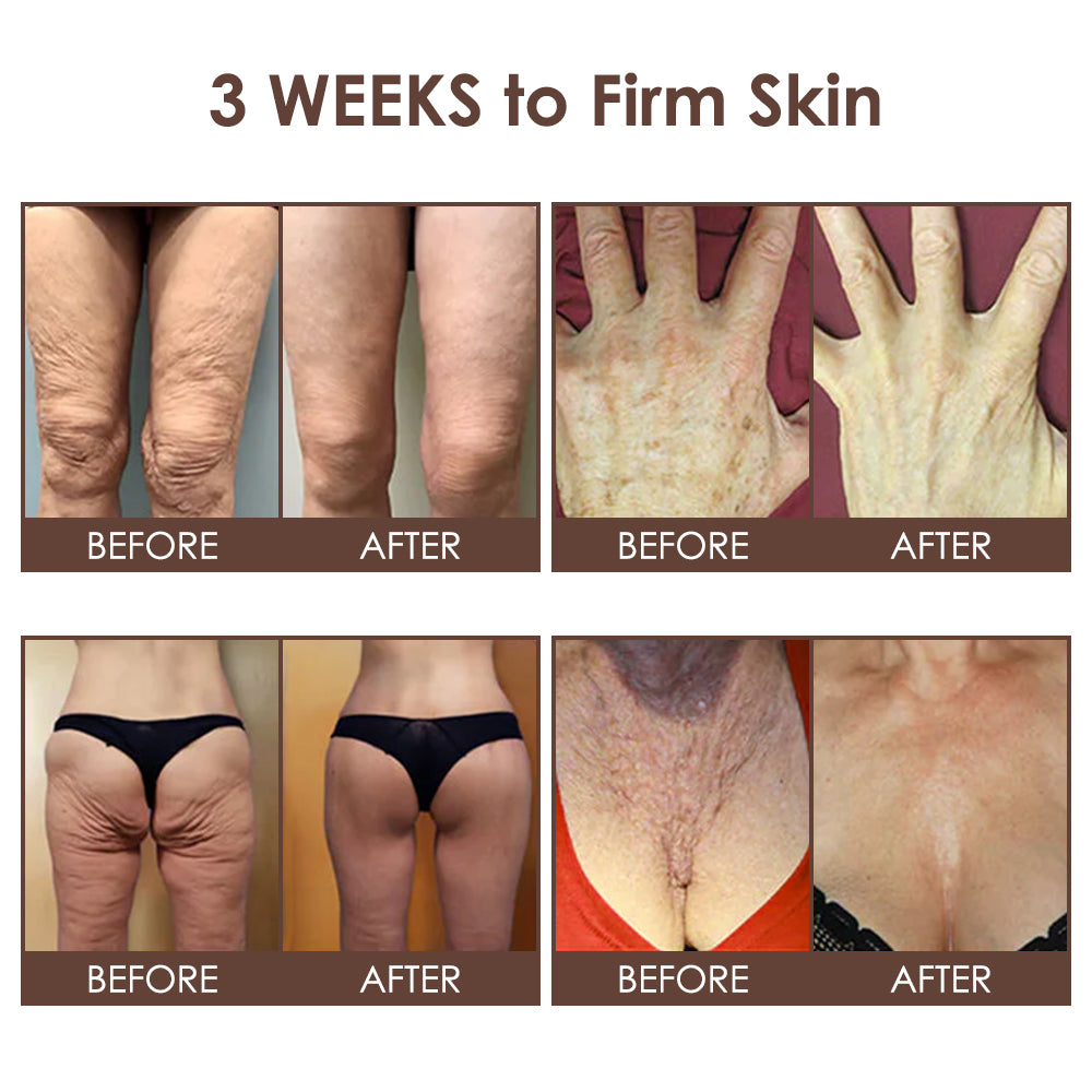 𝐅𝐃𝐀 𝐎𝐟𝐟𝐢𝐜𝐢𝐚𝐥: 𝐙𝐯𝐨𝐞𝐯𝐨® 𝐓𝐚𝐥𝐥𝐨𝐰 𝐁𝐞𝐞 𝐕𝐞𝐧𝐨𝐦 𝐒𝐤𝐢𝐧 𝐑𝐞𝐬𝐭𝐨𝐫𝐚𝐭𝐢𝐨𝐧 𝐂𝐫𝐞𝐚𝐦 - 𝐀𝐧𝐭𝐢-𝐚𝐠𝐢𝐧𝐠, 𝐇𝐲𝐝𝐫𝐚𝐭𝐢𝐧𝐠, 𝐒𝐤𝐢𝐧 𝐅𝐢𝐫𝐦𝐢𝐧𝐠 & 𝐋𝐢𝐟𝐭𝐢𝐧𝐠, 𝐒𝐤𝐢𝐧 𝐑𝐞𝐩𝐚𝐢𝐫, 𝐄𝐯𝐞𝐧 𝐓𝐨𝐧𝐞, 𝐀𝐜𝐧𝐞 𝐚𝐧𝐝 𝐃𝐚𝐫𝐤 𝐒𝐩𝐨𝐭 𝐓𝐫𝐞𝐚𝐭𝐦𝐞𝐧𝐭, 𝐖𝐚𝐫𝐭 𝐚𝐧𝐝 𝐌𝐨𝐥𝐞 𝐑𝐞𝐦𝐨𝐯𝐚𝐥, 𝐚𝐧𝐝 𝐏𝐬𝐨𝐫𝐢𝐚𝐬𝐢𝐬 𝐑𝐞𝐥𝐢𝐞𝐟.