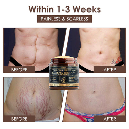 𝐅𝐃𝐀 𝐎𝐟𝐟𝐢𝐜𝐢𝐚𝐥: 𝐙𝐯𝐨𝐞𝐯𝐨® 𝐓𝐚𝐥𝐥𝐨𝐰 𝐁𝐞𝐞 𝐕𝐞𝐧𝐨𝐦 𝐒𝐤𝐢𝐧 𝐑𝐞𝐬𝐭𝐨𝐫𝐚𝐭𝐢𝐨𝐧 𝐂𝐫𝐞𝐚𝐦 - 𝐀𝐧𝐭𝐢-𝐚𝐠𝐢𝐧𝐠, 𝐇𝐲𝐝𝐫𝐚𝐭𝐢𝐧𝐠, 𝐒𝐤𝐢𝐧 𝐅𝐢𝐫𝐦𝐢𝐧𝐠 & 𝐋𝐢𝐟𝐭𝐢𝐧𝐠, 𝐒𝐤𝐢𝐧 𝐑𝐞𝐩𝐚𝐢𝐫, 𝐄𝐯𝐞𝐧 𝐓𝐨𝐧𝐞, 𝐀𝐜𝐧𝐞 𝐚𝐧𝐝 𝐃𝐚𝐫𝐤 𝐒𝐩𝐨𝐭 𝐓𝐫𝐞𝐚𝐭𝐦𝐞𝐧𝐭, 𝐖𝐚𝐫𝐭 𝐚𝐧𝐝 𝐌𝐨𝐥𝐞 𝐑𝐞𝐦𝐨𝐯𝐚𝐥, 𝐚𝐧𝐝 𝐏𝐬𝐨𝐫𝐢𝐚𝐬𝐢𝐬 𝐑𝐞𝐥𝐢𝐞𝐟.