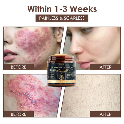 𝐅𝐃𝐀 𝐎𝐟𝐟𝐢𝐜𝐢𝐚𝐥: 𝐙𝐯𝐨𝐞𝐯𝐨® 𝐓𝐚𝐥𝐥𝐨𝐰 𝐁𝐞𝐞 𝐕𝐞𝐧𝐨𝐦 𝐒𝐤𝐢𝐧 𝐑𝐞𝐬𝐭𝐨𝐫𝐚𝐭𝐢𝐨𝐧 𝐂𝐫𝐞𝐚𝐦 - 𝐀𝐧𝐭𝐢-𝐚𝐠𝐢𝐧𝐠, 𝐇𝐲𝐝𝐫𝐚𝐭𝐢𝐧𝐠, 𝐒𝐤𝐢𝐧 𝐅𝐢𝐫𝐦𝐢𝐧𝐠 & 𝐋𝐢𝐟𝐭𝐢𝐧𝐠, 𝐒𝐤𝐢𝐧 𝐑𝐞𝐩𝐚𝐢𝐫, 𝐄𝐯𝐞𝐧 𝐓𝐨𝐧𝐞, 𝐀𝐜𝐧𝐞 𝐚𝐧𝐝 𝐃𝐚𝐫𝐤 𝐒𝐩𝐨𝐭 𝐓𝐫𝐞𝐚𝐭𝐦𝐞𝐧𝐭, 𝐖𝐚𝐫𝐭 𝐚𝐧𝐝 𝐌𝐨𝐥𝐞 𝐑𝐞𝐦𝐨𝐯𝐚𝐥, 𝐚𝐧𝐝 𝐏𝐬𝐨𝐫𝐢𝐚𝐬𝐢𝐬 𝐑𝐞𝐥𝐢𝐞𝐟.