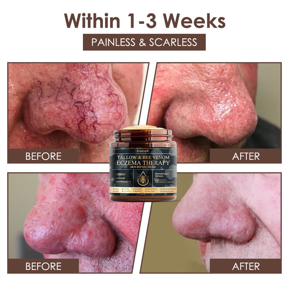 𝐅𝐃𝐀 𝐎𝐟𝐟𝐢𝐜𝐢𝐚𝐥: 𝐙𝐯𝐨𝐞𝐯𝐨® 𝐓𝐚𝐥𝐥𝐨𝐰 𝐁𝐞𝐞 𝐕𝐞𝐧𝐨𝐦 𝐒𝐤𝐢𝐧 𝐑𝐞𝐬𝐭𝐨𝐫𝐚𝐭𝐢𝐨𝐧 𝐂𝐫𝐞𝐚𝐦 - 𝐀𝐧𝐭𝐢-𝐚𝐠𝐢𝐧𝐠, 𝐇𝐲𝐝𝐫𝐚𝐭𝐢𝐧𝐠, 𝐒𝐤𝐢𝐧 𝐅𝐢𝐫𝐦𝐢𝐧𝐠 & 𝐋𝐢𝐟𝐭𝐢𝐧𝐠, 𝐒𝐤𝐢𝐧 𝐑𝐞𝐩𝐚𝐢𝐫, 𝐄𝐯𝐞𝐧 𝐓𝐨𝐧𝐞, 𝐀𝐜𝐧𝐞 𝐚𝐧𝐝 𝐃𝐚𝐫𝐤 𝐒𝐩𝐨𝐭 𝐓𝐫𝐞𝐚𝐭𝐦𝐞𝐧𝐭, 𝐖𝐚𝐫𝐭 𝐚𝐧𝐝 𝐌𝐨𝐥𝐞 𝐑𝐞𝐦𝐨𝐯𝐚𝐥, 𝐚𝐧𝐝 𝐏𝐬𝐨𝐫𝐢𝐚𝐬𝐢𝐬 𝐑𝐞𝐥𝐢𝐞𝐟.
