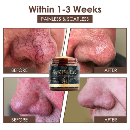 𝐅𝐃𝐀 𝐎𝐟𝐟𝐢𝐜𝐢𝐚𝐥: 𝐙𝐯𝐨𝐞𝐯𝐨® 𝐓𝐚𝐥𝐥𝐨𝐰 𝐁𝐞𝐞 𝐕𝐞𝐧𝐨𝐦 𝐒𝐤𝐢𝐧 𝐑𝐞𝐬𝐭𝐨𝐫𝐚𝐭𝐢𝐨𝐧 𝐂𝐫𝐞𝐚𝐦 - 𝐀𝐧𝐭𝐢-𝐚𝐠𝐢𝐧𝐠, 𝐇𝐲𝐝𝐫𝐚𝐭𝐢𝐧𝐠, 𝐒𝐤𝐢𝐧 𝐅𝐢𝐫𝐦𝐢𝐧𝐠 & 𝐋𝐢𝐟𝐭𝐢𝐧𝐠, 𝐒𝐤𝐢𝐧 𝐑𝐞𝐩𝐚𝐢𝐫, 𝐄𝐯𝐞𝐧 𝐓𝐨𝐧𝐞, 𝐀𝐜𝐧𝐞 𝐚𝐧𝐝 𝐃𝐚𝐫𝐤 𝐒𝐩𝐨𝐭 𝐓𝐫𝐞𝐚𝐭𝐦𝐞𝐧𝐭, 𝐖𝐚𝐫𝐭 𝐚𝐧𝐝 𝐌𝐨𝐥𝐞 𝐑𝐞𝐦𝐨𝐯𝐚𝐥, 𝐚𝐧𝐝 𝐏𝐬𝐨𝐫𝐢𝐚𝐬𝐢𝐬 𝐑𝐞𝐥𝐢𝐞𝐟.