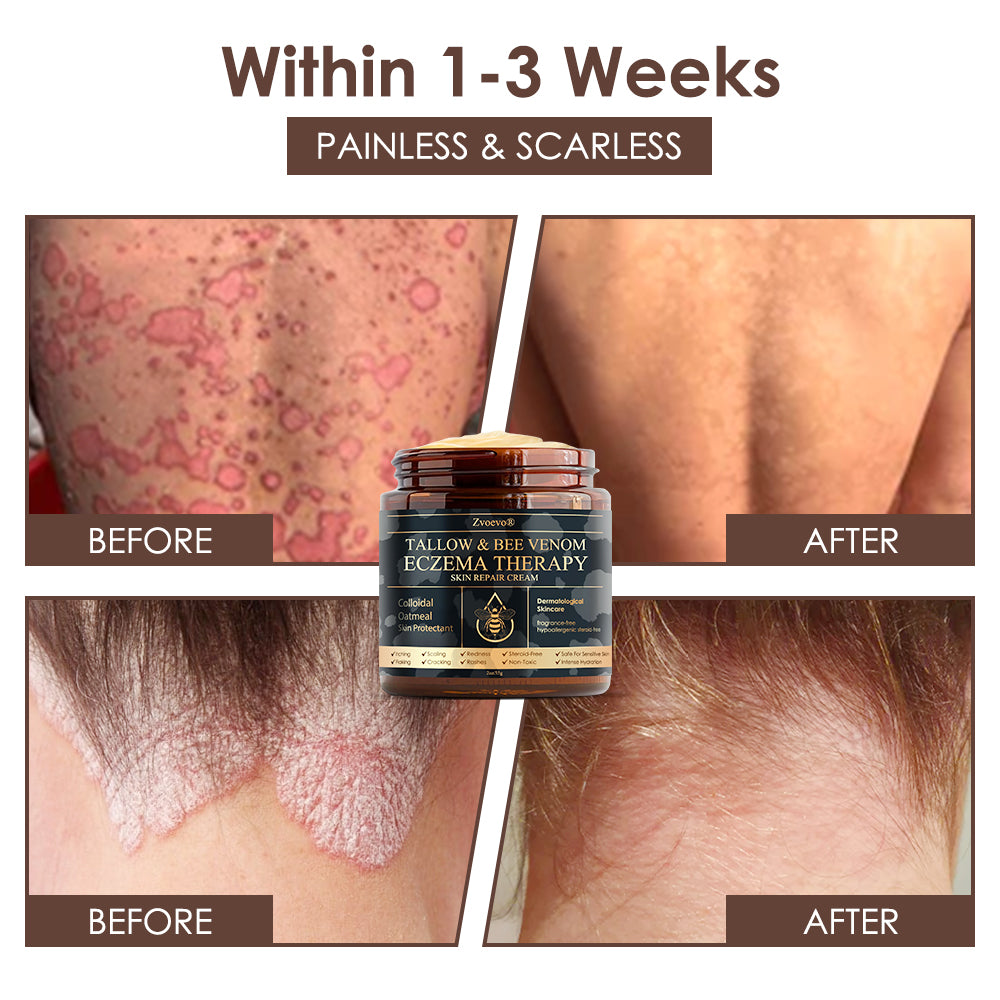𝐅𝐃𝐀 𝐎𝐟𝐟𝐢𝐜𝐢𝐚𝐥: 𝐙𝐯𝐨𝐞𝐯𝐨® 𝐓𝐚𝐥𝐥𝐨𝐰 𝐁𝐞𝐞 𝐕𝐞𝐧𝐨𝐦 𝐒𝐤𝐢𝐧 𝐑𝐞𝐬𝐭𝐨𝐫𝐚𝐭𝐢𝐨𝐧 𝐂𝐫𝐞𝐚𝐦 - 𝐀𝐧𝐭𝐢-𝐚𝐠𝐢𝐧𝐠, 𝐇𝐲𝐝𝐫𝐚𝐭𝐢𝐧𝐠, 𝐒𝐤𝐢𝐧 𝐅𝐢𝐫𝐦𝐢𝐧𝐠 & 𝐋𝐢𝐟𝐭𝐢𝐧𝐠, 𝐒𝐤𝐢𝐧 𝐑𝐞𝐩𝐚𝐢𝐫, 𝐄𝐯𝐞𝐧 𝐓𝐨𝐧𝐞, 𝐀𝐜𝐧𝐞 𝐚𝐧𝐝 𝐃𝐚𝐫𝐤 𝐒𝐩𝐨𝐭 𝐓𝐫𝐞𝐚𝐭𝐦𝐞𝐧𝐭, 𝐖𝐚𝐫𝐭 𝐚𝐧𝐝 𝐌𝐨𝐥𝐞 𝐑𝐞𝐦𝐨𝐯𝐚𝐥, 𝐚𝐧𝐝 𝐏𝐬𝐨𝐫𝐢𝐚𝐬𝐢𝐬 𝐑𝐞𝐥𝐢𝐞𝐟.