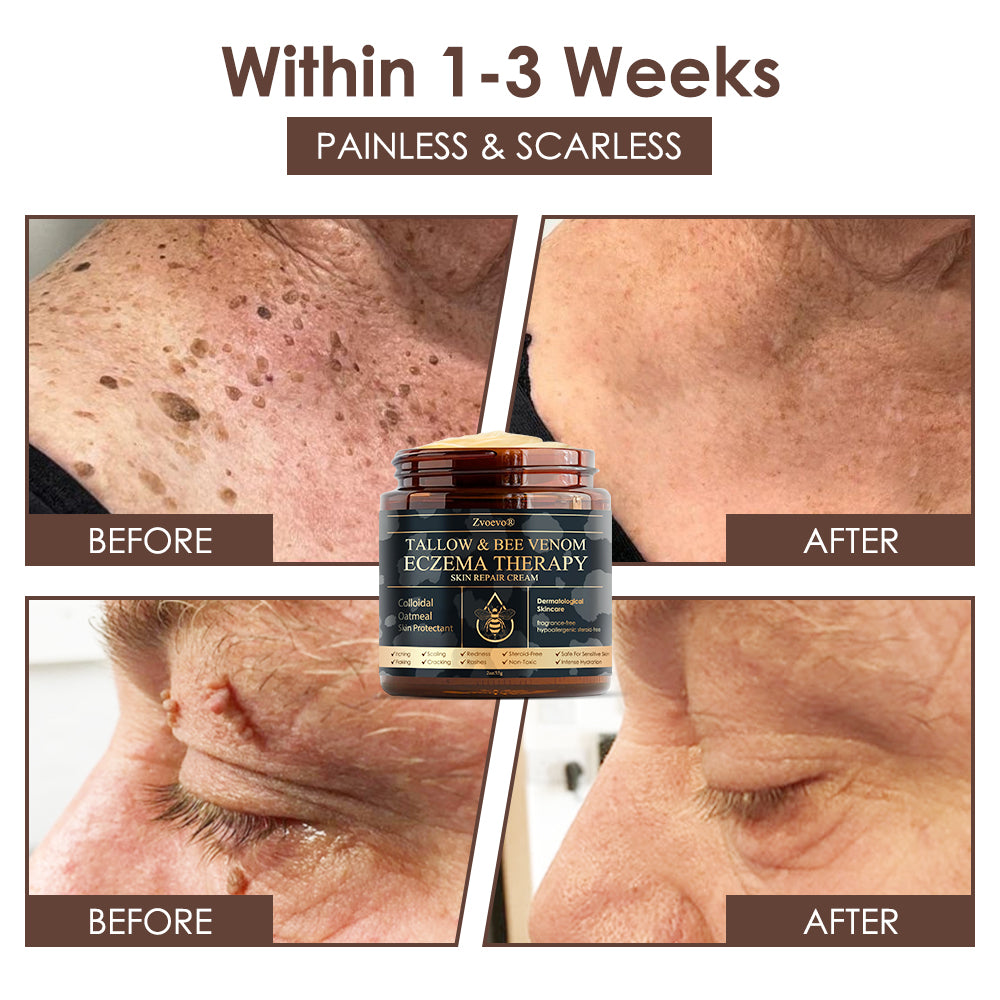 𝐅𝐃𝐀 𝐎𝐟𝐟𝐢𝐜𝐢𝐚𝐥: 𝐙𝐯𝐨𝐞𝐯𝐨® 𝐓𝐚𝐥𝐥𝐨𝐰 𝐁𝐞𝐞 𝐕𝐞𝐧𝐨𝐦 𝐒𝐤𝐢𝐧 𝐑𝐞𝐬𝐭𝐨𝐫𝐚𝐭𝐢𝐨𝐧 𝐂𝐫𝐞𝐚𝐦 - 𝐀𝐧𝐭𝐢-𝐚𝐠𝐢𝐧𝐠, 𝐇𝐲𝐝𝐫𝐚𝐭𝐢𝐧𝐠, 𝐒𝐤𝐢𝐧 𝐅𝐢𝐫𝐦𝐢𝐧𝐠 & 𝐋𝐢𝐟𝐭𝐢𝐧𝐠, 𝐒𝐤𝐢𝐧 𝐑𝐞𝐩𝐚𝐢𝐫, 𝐄𝐯𝐞𝐧 𝐓𝐨𝐧𝐞, 𝐀𝐜𝐧𝐞 𝐚𝐧𝐝 𝐃𝐚𝐫𝐤 𝐒𝐩𝐨𝐭 𝐓𝐫𝐞𝐚𝐭𝐦𝐞𝐧𝐭, 𝐖𝐚𝐫𝐭 𝐚𝐧𝐝 𝐌𝐨𝐥𝐞 𝐑𝐞𝐦𝐨𝐯𝐚𝐥, 𝐚𝐧𝐝 𝐏𝐬𝐨𝐫𝐢𝐚𝐬𝐢𝐬 𝐑𝐞𝐥𝐢𝐞𝐟.